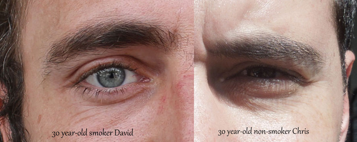 Skin affected by smoking cigarettes