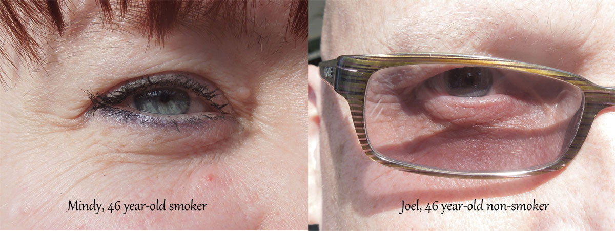 Skin affected by smoking cigarettes