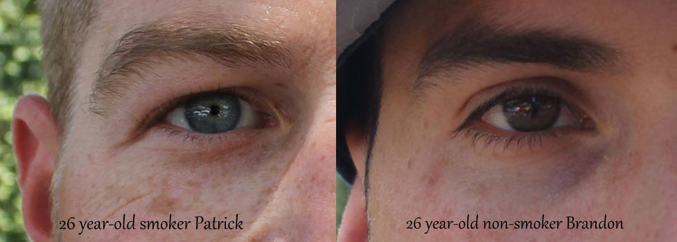 Skin affected by smoking cigarettes