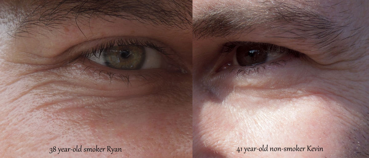 Skin affected by smoking cigarettes