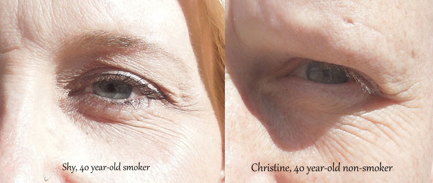 Skin affected by smoking cigarettes